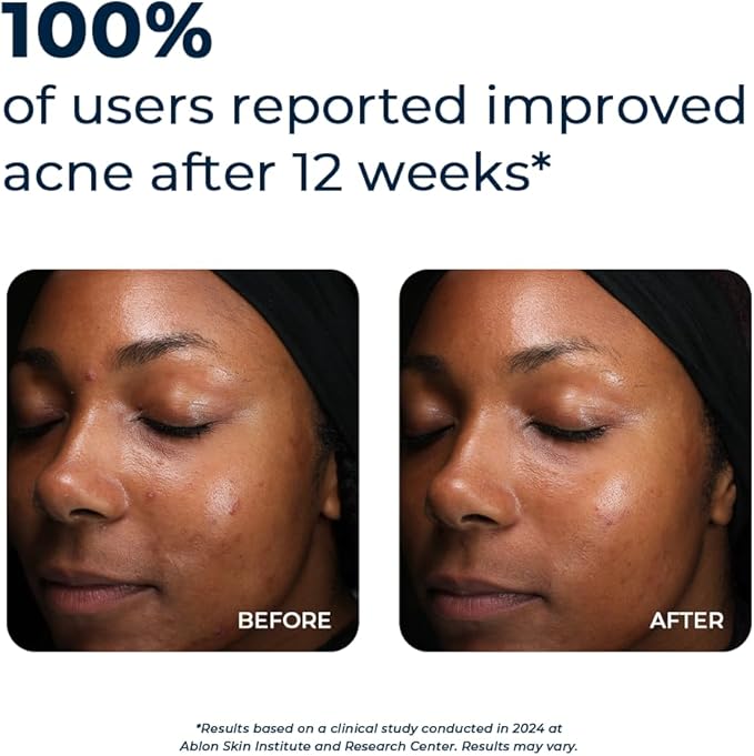 VitaMedica Clear Skin Vitamin Formula | Noncystic Acne Supplement for Skin Clearing | Breakout Treatment for Women and Men | Vitamins A, C, E, Selenium, Chromium, and Zinc for Skin Health | 2 Pack