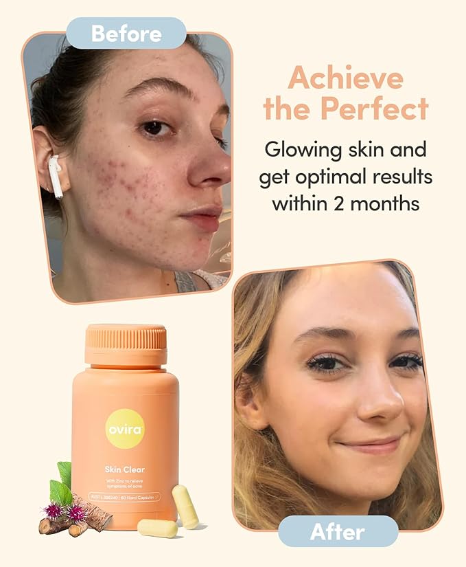 Ovira Skin Clear with ZINCBRIGHT - 60 Capsules for Clear and Glowing Skin | Rosacea & Hormonal Acne Treatment | Support Collagen Production | Acne Supplements for Women & Men - Pack of 1