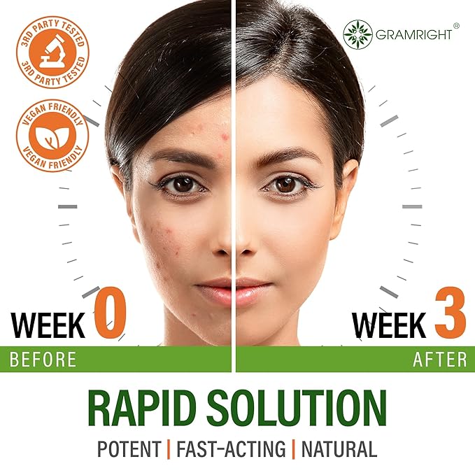 Perfect Skin Acne Capsules – Niacinamide, Biotin, Vitamin A & Probiotics for Teens & Adults – 13 Powerful Ingredients for Face Acne, Acne Scars & Dark Spots – 60 Vegan Capsules, Made in the USA
