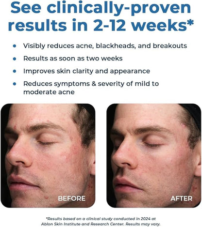 VitaMedica Clear Skin Vitamin Formula | Noncystic Acne Supplement for Skin Clearing | Breakout Treatment for Women and Men | Vitamins A, C, E, Selenium, Chromium, and Zinc for Skin Health | 2 Pack