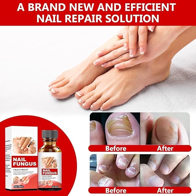 Toenail Fungus Treatment Extra Strength, Nail Fungus Treatment for Toenail, Toe Nail Fungus Treatments for Athletes Foot,Thick, Broken & Damaged, Natural Plant Extracts Gently & Safely