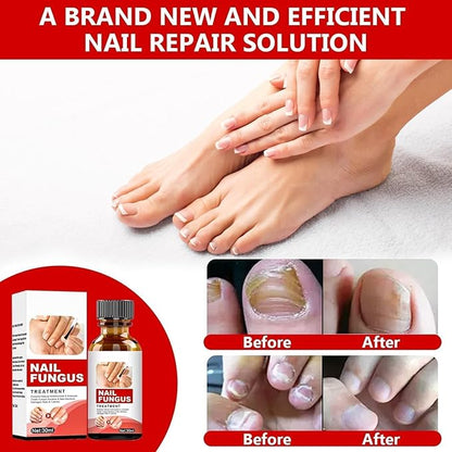Toenail Fungus Treatment Extra Strength, Nail Fungus Treatment for Toenail, Toe Nail Fungus Treatments for Athletes Foot,Thick, Broken & Damaged, Natural Plant Extracts Gently & Safely