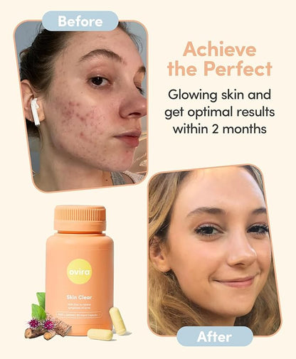 Ovira Skin Clear with ZINCBRIGHT - 60 Capsules for Clear and Glowing Skin | Rosacea & Hormonal Acne Treatment | Support Collagen Production | Acne Supplements for Women & Men - Pack of 4