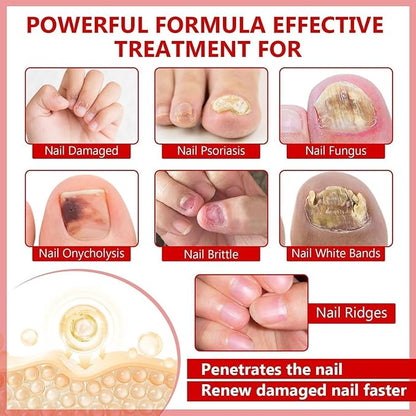 Toenail Fungus Treatment Extra Strength, Nail Fungus Treatment for Toenail, Toe Nail Fungus Treatments for Athletes Foot,Thick, Broken & Damaged, Natural Plant Extracts Gently & Safely