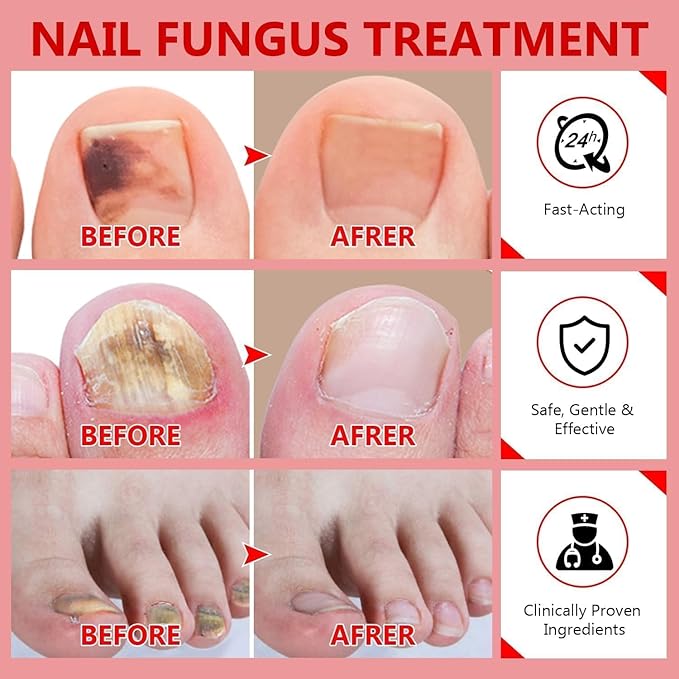 Toenail Fungus Treatment Extra Strength, Nail Fungus Treatment for Toenail, Toe Nail Fungus Treatments for Athletes Foot,Thick, Broken & Damaged, Natural Plant Extracts Gently & Safely